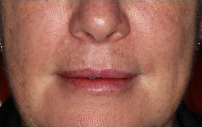 Lips after filler